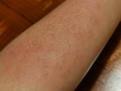 小棘苔蘚右胳膊有大面積紅斑伴有丘疹圖