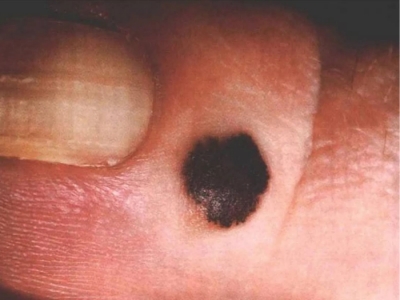 原位惡性黑色素瘤腳趾上長了一個黑點圖 原位惡性黑色素瘤腳趾上長了一個黑點圖