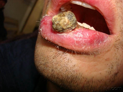 愛滋病皮膚腫瘤嘴唇邊長結節表面結痂圖 愛滋病皮膚腫瘤嘴唇邊長結節表面結痂圖