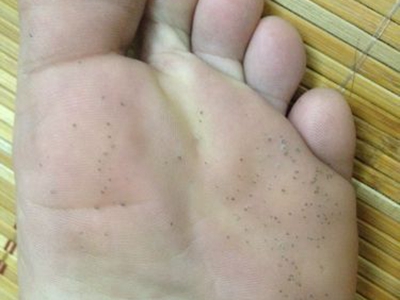 溝狀跖部角質松解症腳底有發黑的小坑圖