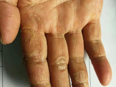 手部濕疹右手手指關節處部分皮膚增厚圖 手部濕疹右手手指關節處部分皮膚增厚圖