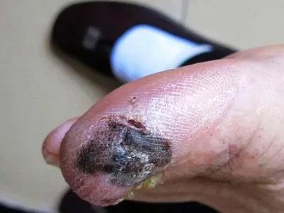 肢端雀斑樣痣型黑色素瘤大腳趾長黑斑圖