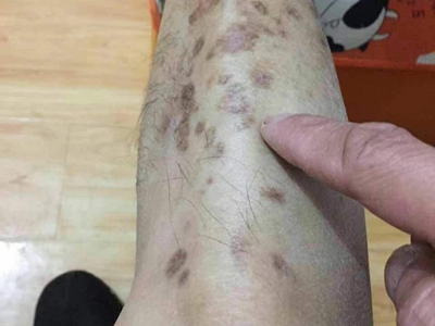 糖尿病性皮膚病小腿上有好多暗紅色斑圖 糖尿病性皮膚病小腿上有好多暗紅色斑圖