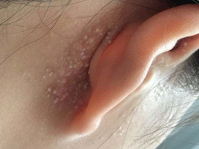 繼發性粟丘疹耳朵後面有密集的小白點圖