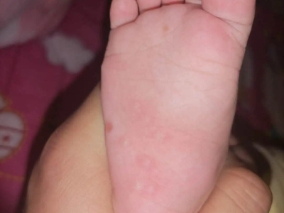 幼年跖部皮病腳底紋路明顯局部有紅斑圖
