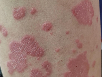 尋常型銀屑病大腿上長凸起的紅色斑塊圖