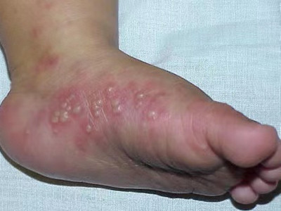 嬰兒肢端膿皰病腳上長數量較多的水皰圖 嬰兒肢端膿皰病腳上長數量較多的水皰圖
