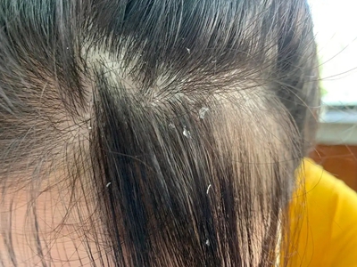 頭皮糠疹頭皮上大量細小頭皮屑脫落圖 頭皮糠疹頭皮上大量細小頭皮屑脫落圖