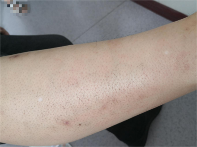 特發性滴狀色素減少症小腿有兩片白斑圖 特發性滴狀色素減少症小腿有兩片白斑圖