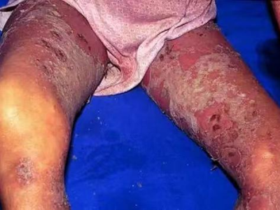 皰疹樣膿皰病大腿膿皰破裂後結痂脫皮圖 皰疹樣膿皰病大腿膿皰破裂後結痂脫皮圖
