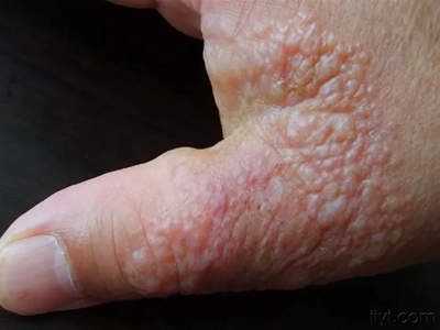 職業性光變應性接觸性皮炎大拇指水皰圖 職業性光變應性接觸性皮炎大拇指水皰圖