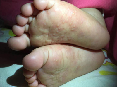 嬰兒肢端膿皰病腳底長密密麻麻的水皰圖