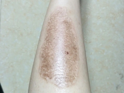 咖啡斑小腿上有一大片淺棕色不規則斑圖