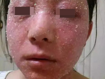糖皮質激素依賴性皮炎臉上大面積脫皮圖