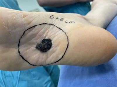 肢端雀斑樣痣型黑色素瘤腳心有個黑斑圖 肢端雀斑樣痣型黑色素瘤腳心有個黑斑圖