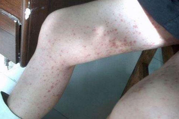 小兒過敏性紫癜大腿散布紫紅色小斑點圖 小兒過敏性紫癜大腿散布紫紅色小斑點圖