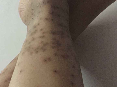 蚋叮咬引起的皮膚反應小腿很多褐色斑圖 蚋叮咬引起的皮膚反應小腿很多褐色斑圖