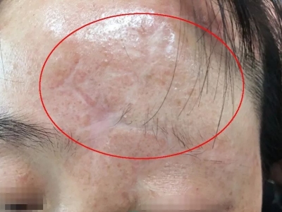 硬化性汗腺導管癌額頭上有凹陷的白斑圖 硬化性汗腺導管癌額頭上有凹陷的白斑圖