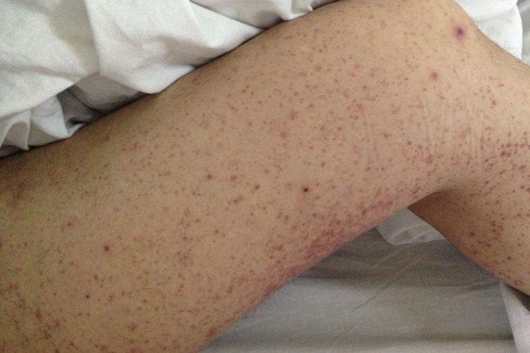 小兒過敏性紫癜左側大腿有紅色小斑點圖