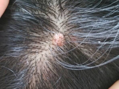 網狀組織細胞肉芽腫頭頂有膚色小疙瘩圖 網狀組織細胞肉芽腫頭頂有膚色小疙瘩圖