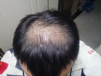 雄激素性脫髮頭頂有一大塊的頭髮稀疏圖