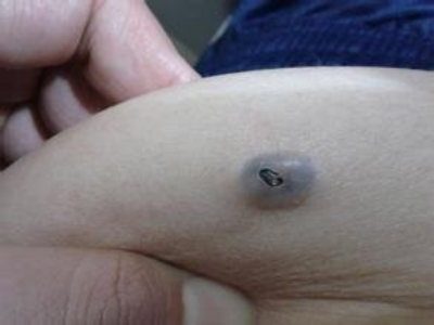 皮脂腺囊腫肚子上長了一個藍黑色疙瘩圖 皮脂腺囊腫肚子上長了一個藍黑色疙瘩圖