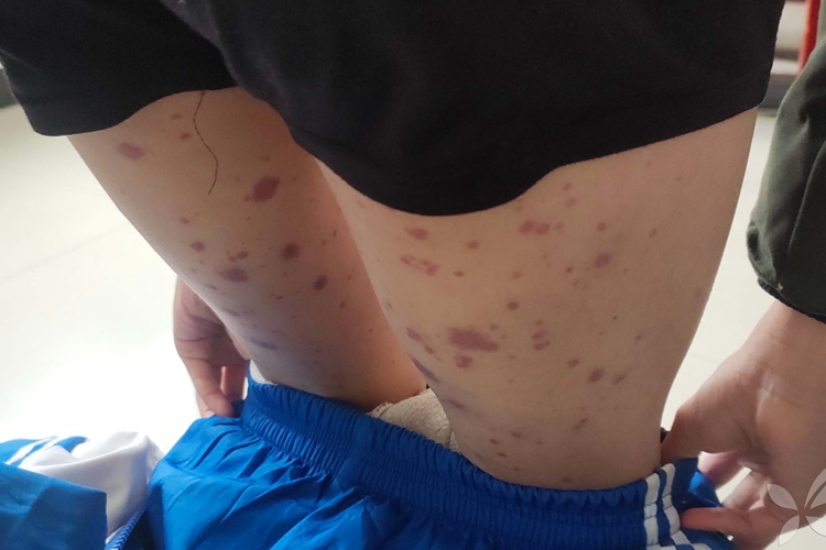 小兒過敏性紫癜大腿對稱分布紫紅色斑圖