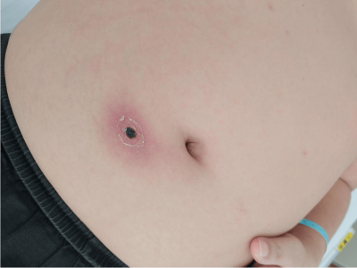 恙蟲病腹部有一塊凹陷性黑痂圖 恙蟲病腹部有一塊凹陷性黑痂圖
