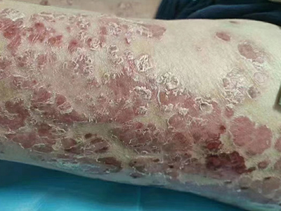 尋常型銀屑病大腿大面積出現紅斑脫皮圖 尋常型銀屑病大腿大面積出現紅斑脫皮圖