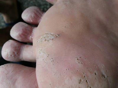 溝狀跖部角質松解症腳底很多小坑發黑圖 溝狀跖部角質松解症腳底很多小坑發黑圖