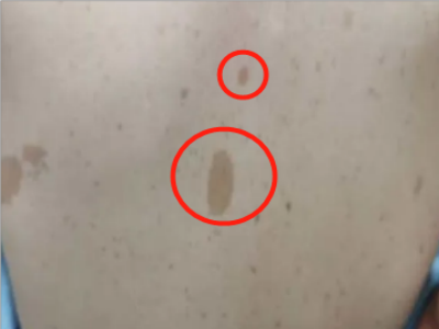 咖啡斑後背上很多大小不等的淺咖色斑圖 咖啡斑後背上很多大小不等的淺咖色斑圖